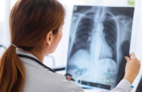 سرطان الرئة.. إصابات متزايدة بين شابات لا يدخنّ