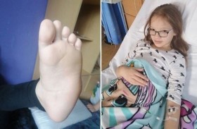طفلة ترغب ببتر قدمها لتتخلص من آلامها