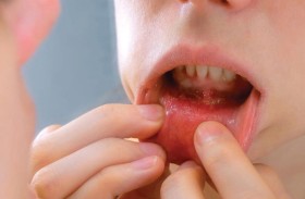 الماريغوانا تضاعف خطر سرطان الفم