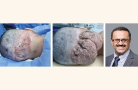 إزالة ورم دموي ليفي بحجم البطيخة من فروة رأس طفلة عربية 5 أعوام في دبي