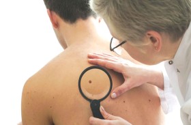 اختصاصية أورام الأطفال تحدد الشامات الخطرة