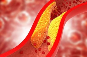 خفض الكوليسترول قد يحدّ من خطر الخرف