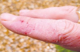 اكتشاف جديد يقلل من أكثر أعراض الأكزيما إزعاجا