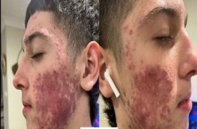 يتخلص من حساسية شديدة بفضل علاج طبيعي