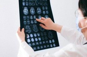 ماذا تعرف عن المادة البيضاء في الدماغ؟
