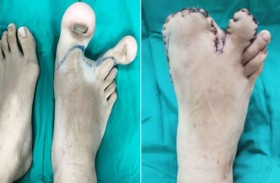 تضخم «صادم» في أصابع قدم طفلة يمنعها من المشي