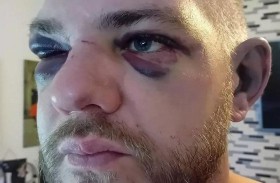 دافع عن فصيلة كلاب متوحشة فتعرض لهجوم أحدها