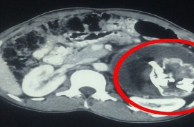 استخراج جنين من بطن رضيع !