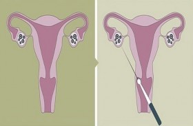 أول مريضة سرطان تنجب بتجميد بويضاتها