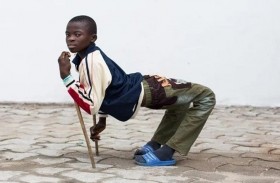 يمشي على أربع بسبب مرض نادر