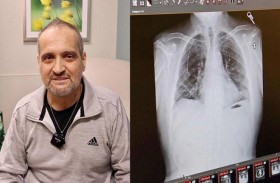 عملية زرع رئتين مزدوجة تنقذ حياة مريض