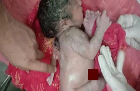 ولادة طفل مع ذراع ثالثة في ظهره 