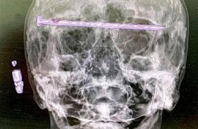 «مسمار» داخل جمجمة رجل 