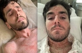 يعالج نفسه بعد إصابته بحساسية شديدة