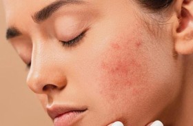 أفضل طريقة لمنع ظهور البثور في الصيف