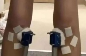 يدفع آلاف الدولارات لعلاج نمو مؤقت يزول في أسبوعين