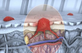 تقنية ثورية للكشف المبكر عن سرطان المريء