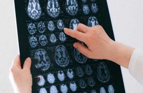 أورام الدماغ.. أكثر أنواع السرطانات فتكاً