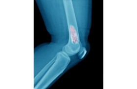 خمسة أعراض يتم تشخيصها بشكل خاطئ قد تشير إلى الإصابة بسرطان العظام