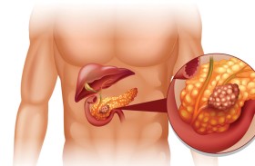 أدوية «ستاتين» تحمي الكبد من السرطان