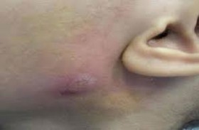 استخراج دودة من خد طفل 