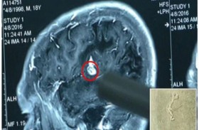 دودة في دماغ رجل منذ 17 عاماً