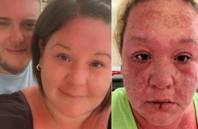 بعوضة تفسد رحلة عاشقين بريطانيين