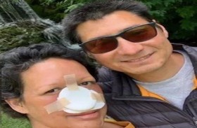 تفقد أنفها بالكامل بسبب السرطان 