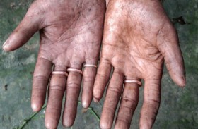 بسبب «طفرة» نادرة.. عائلة بأكملها ولدت بلا بصمات