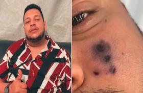 وفاة مغنٍّ برازيلي بلدغة عنكبوت