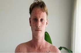 يتخلص من الأكزيما بعلاج ياباني تقليدي