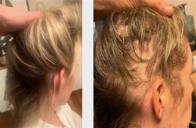 تستعيد شعرها بمكمل غذائي رخيص