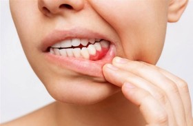 «اللثة المريضة» بوابة للاكتئاب وأمراض القلب