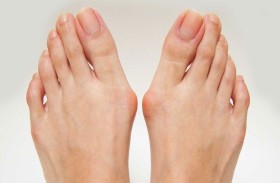 طبيب يوضح سبب نمو العظمة في القدمين