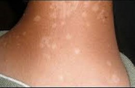  ما هي البقع البيضاء الصغيرة التي تظهر على الجلد؟