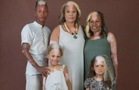 عائلة تشترك في بقع بيضاء بسبب حالة نادرة