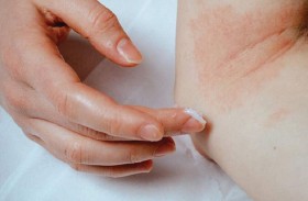 كل ما تحتاج معرفته عن التهاب الجلد الدهني وأفضل طرق الوقاية منه