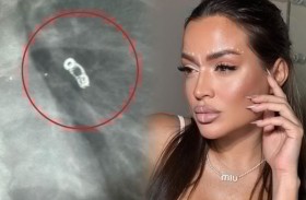 تكتشف جسماً معدنياً  في الرئة بعد خطأ طبي 