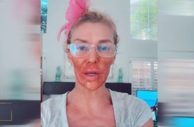 وجه براندي غلانفيل «يحترق» 