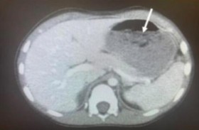 استخراج كتلة علكة ضخمة من معدة طفل 