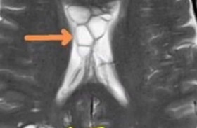 دودة شريطة داخل رأس رجل