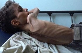 وزنه 7 كيلوغرامات فقط.. الجوع ينهش صبياً يمنياً