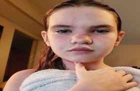 تعاني من حساسية تهدد حياتها