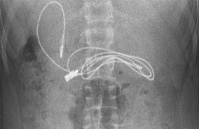 سلك شاحن في معدة مراهق