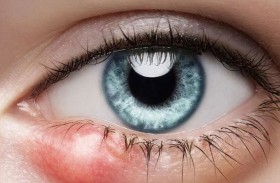 كيف نعالج دمل العين؟