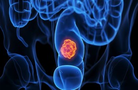 ظاهره حميد.. خطر خفي في الأمعاء قد ينذر بتطور السرطان