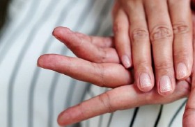 أسباب حرقة اليدين