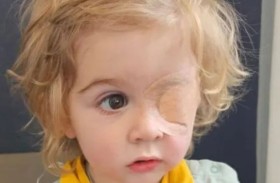 طفل يخسر عينه بعد قبلة من مصاب بالهربس