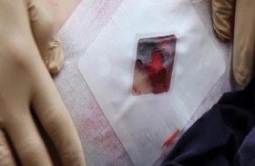 يكتشف شظية مغروسة في كبده منذ 9 أعوام