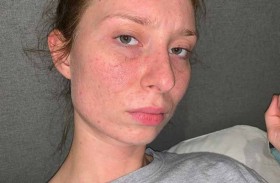 تشفي بشرتها من البثور بالتحول إلى حمية نباتية